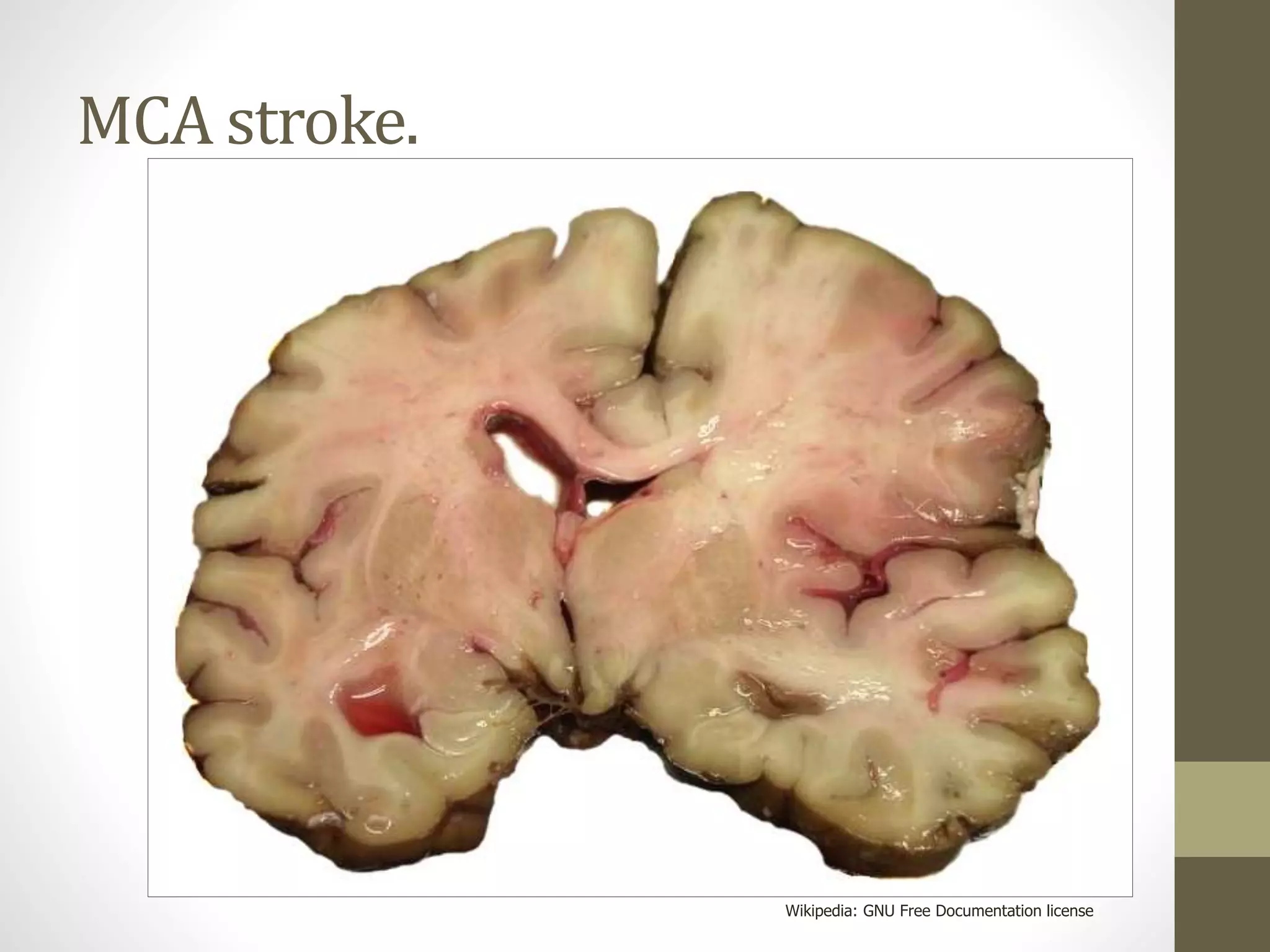 MCA stroke.
Wikipedia: GNU Free Documentation license
 