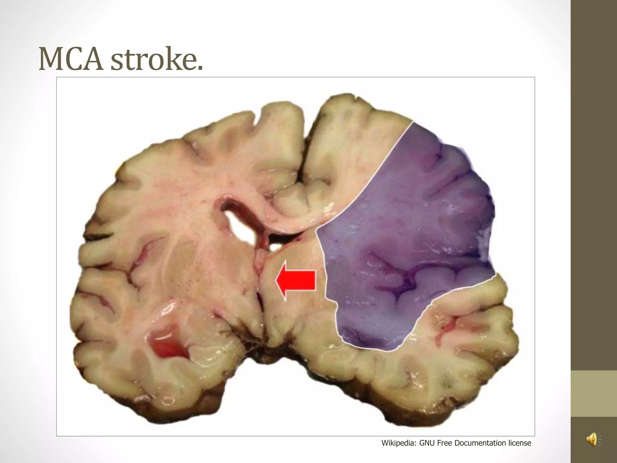 MCA stroke.
Wikipedia: GNU Free Documentation license
 