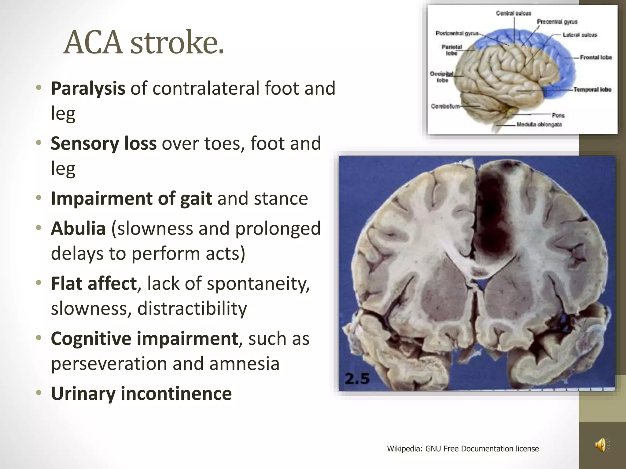 ACA stroke.
• Paralysis of contralateral foot and
leg
• Sensory loss over toes, foot and
leg
• Impairment of gait and stance
• Abulia (slowness and prolonged
delays to perform acts)
• Flat affect, lack of spontaneity,
slowness, distractibility
• Cognitive impairment, such as
perseveration and amnesia
• Urinary incontinence
Wikipedia: GNU Free Documentation license
 