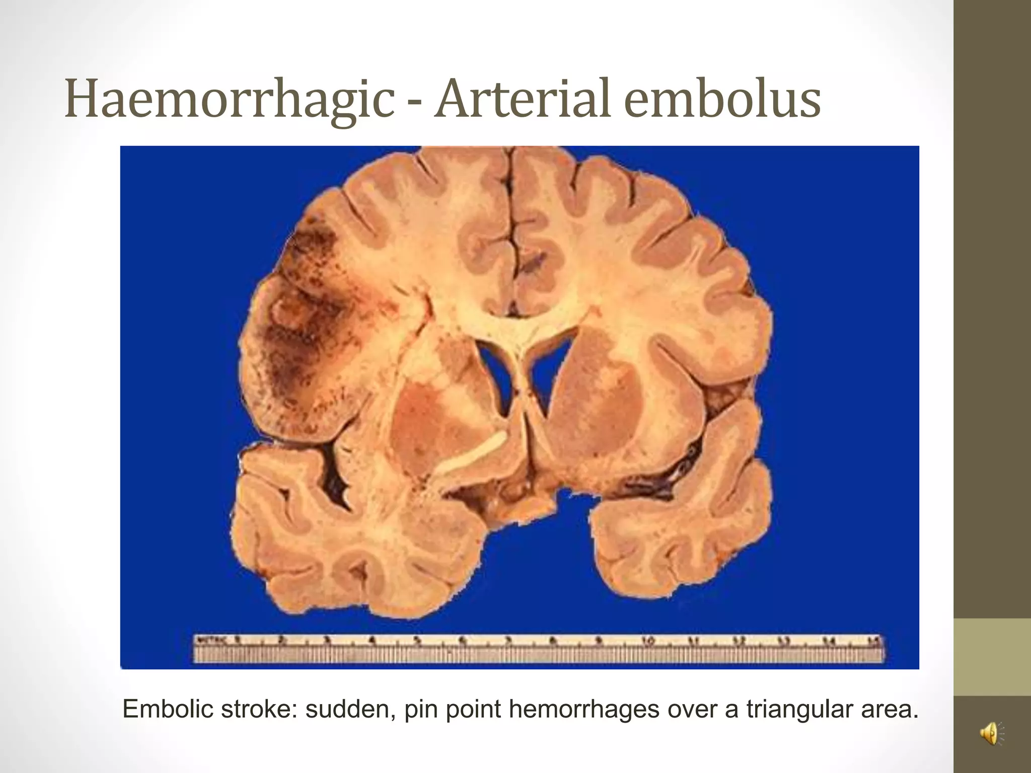 Haemorrhagic - Arterial embolus
Embolic stroke: sudden, pin point hemorrhages over a triangular area.
 