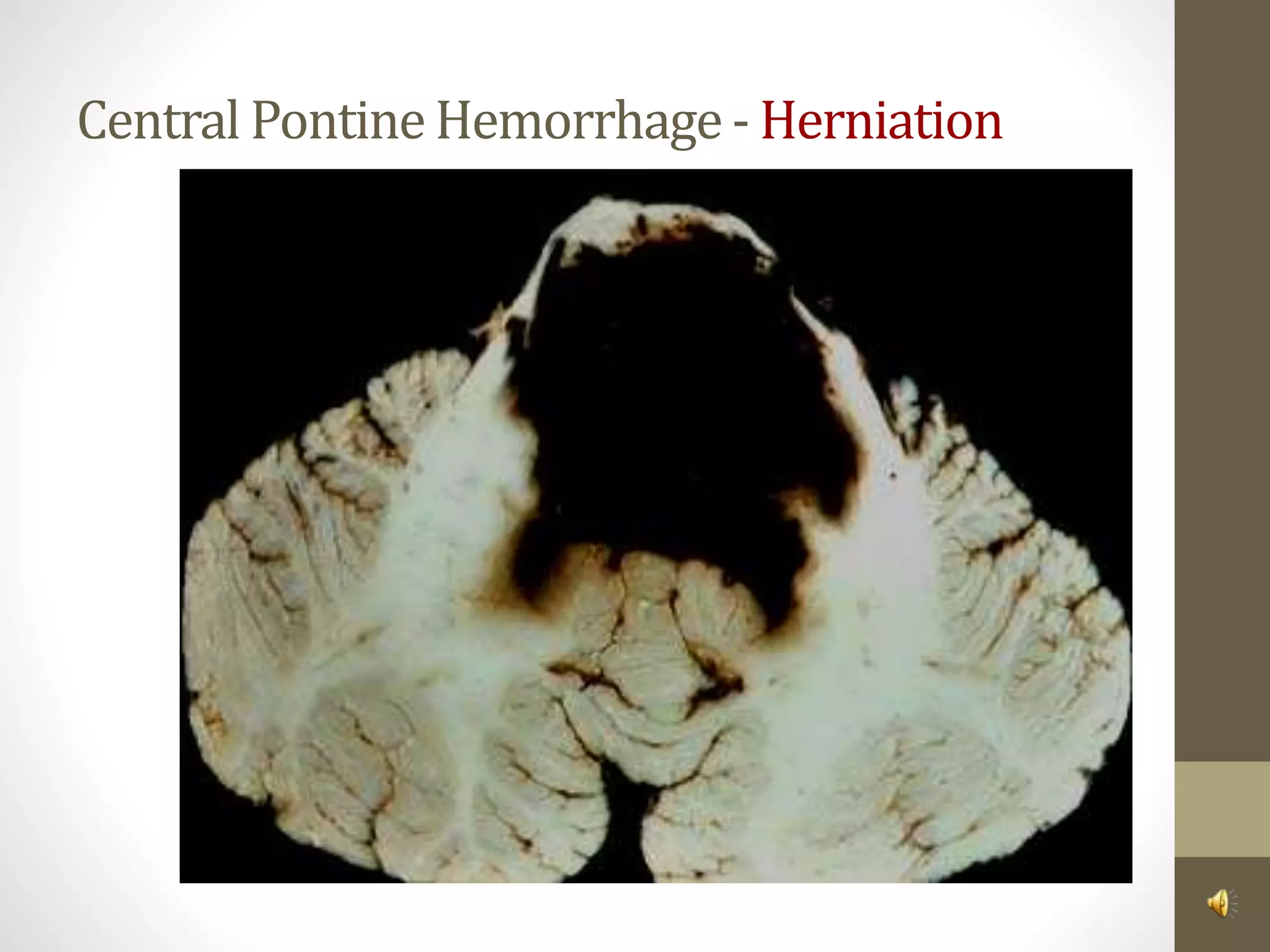 Central PontineHemorrhage- Herniation
 