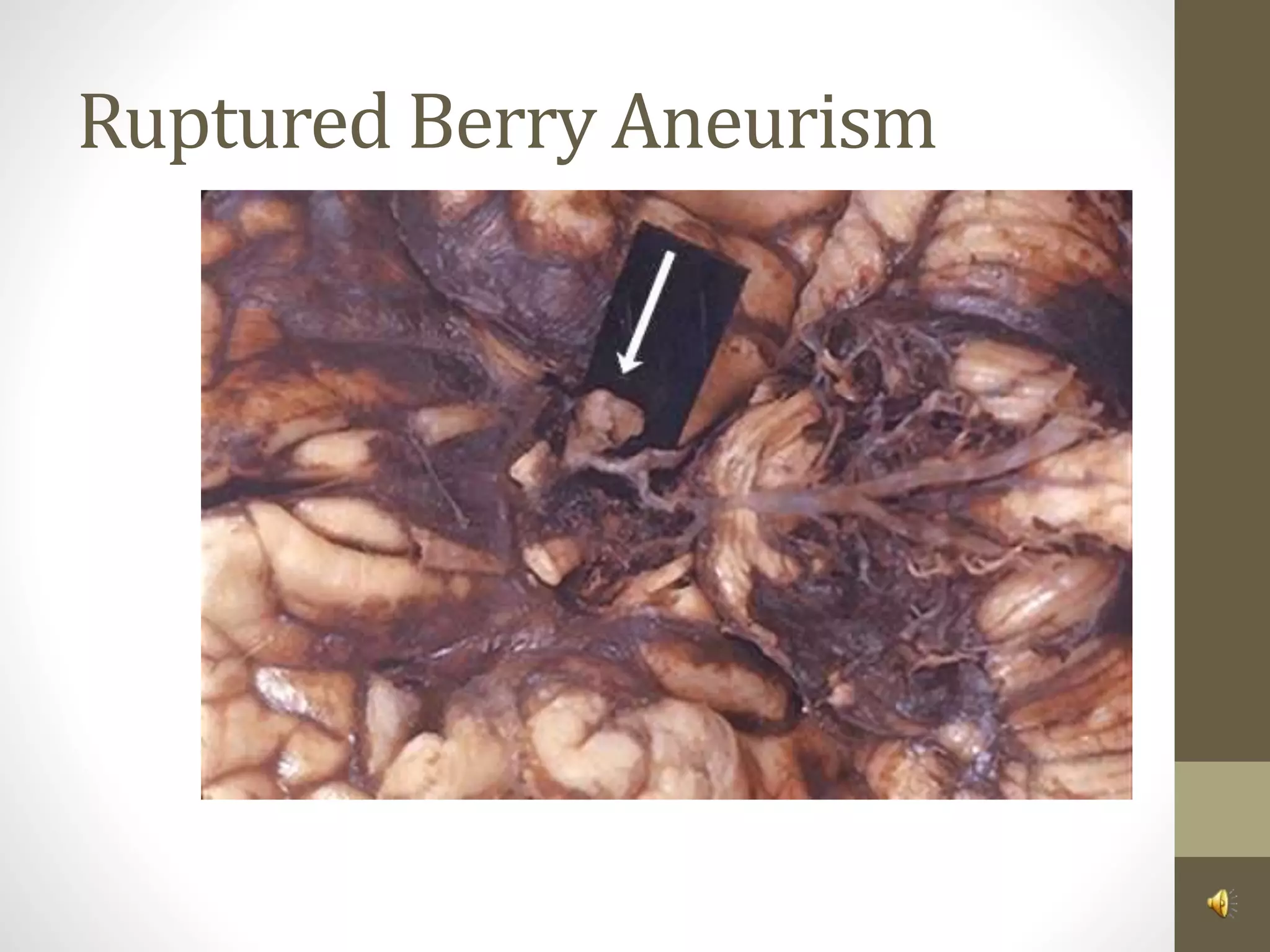 Ruptured Berry Aneurism
 
