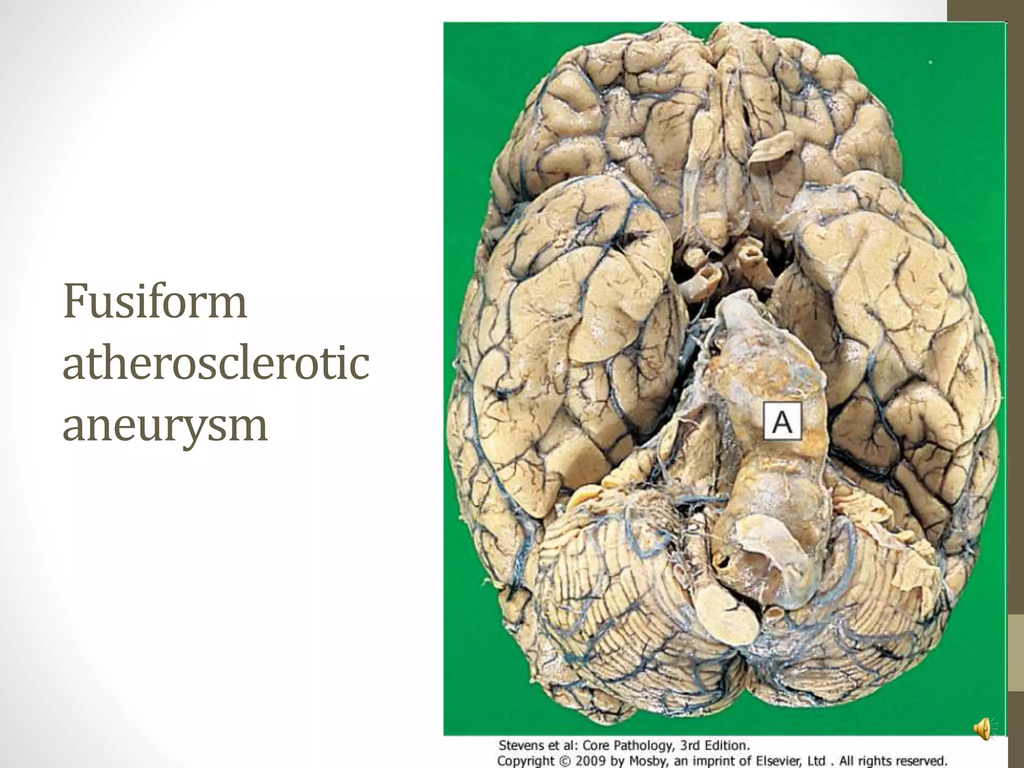 Fusiform
atherosclerotic
aneurysm
 