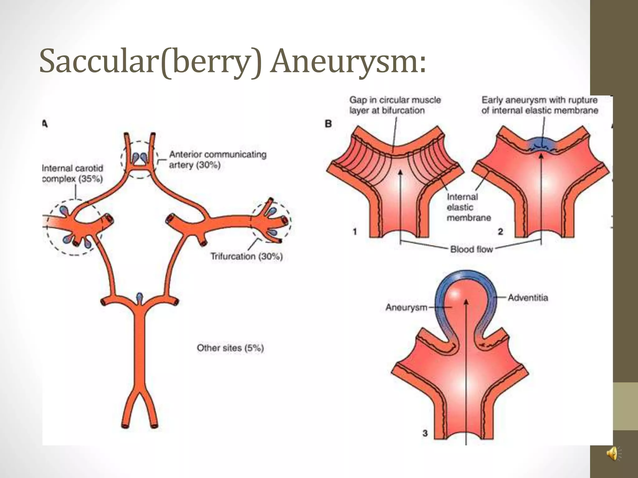 Saccular(berry) Aneurysm:
 