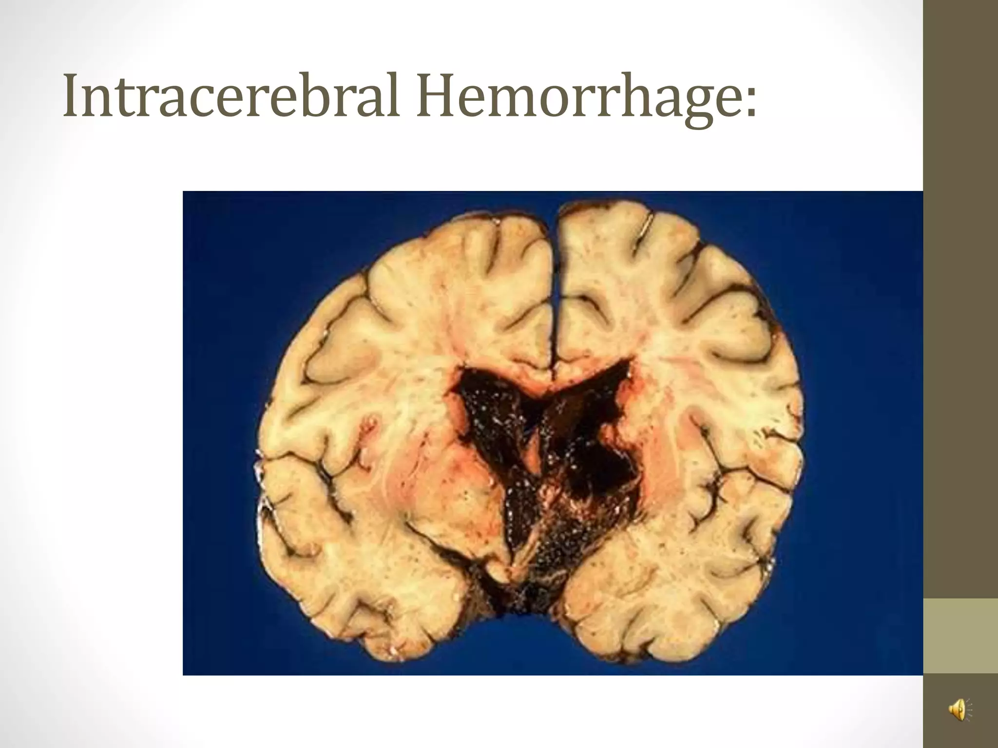 Intracerebral Hemorrhage:
 