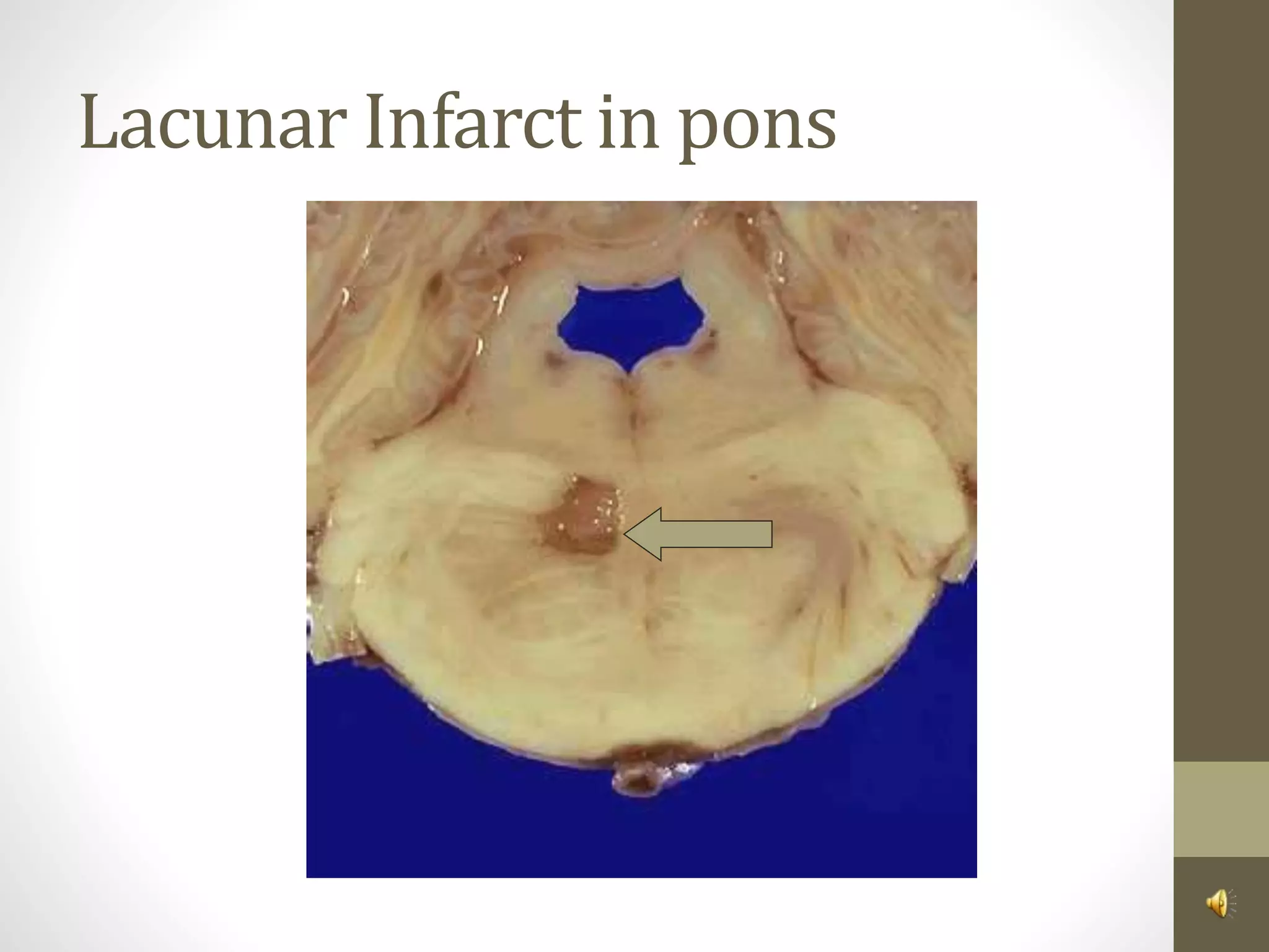 Lacunar Infarct in pons
 