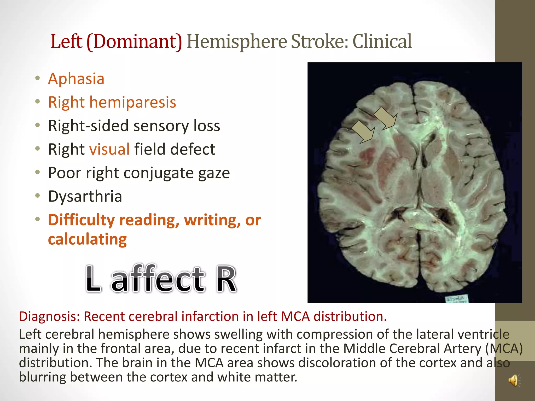 Left(Dominant)HemisphereStroke:Clinical
• Aphasia
• Right hemiparesis
• Right-sided sensory loss
• Right visual field defect
• Poor right conjugate gaze
• Dysarthria
• Difficulty reading, writing, or
calculating
Diagnosis: Recent cerebral infarction in left MCA distribution.
Left cerebral hemisphere shows swelling with compression of the lateral ventricle
mainly in the frontal area, due to recent infarct in the Middle Cerebral Artery (MCA)
distribution. The brain in the MCA area shows discoloration of the cortex and also
blurring between the cortex and white matter.
 