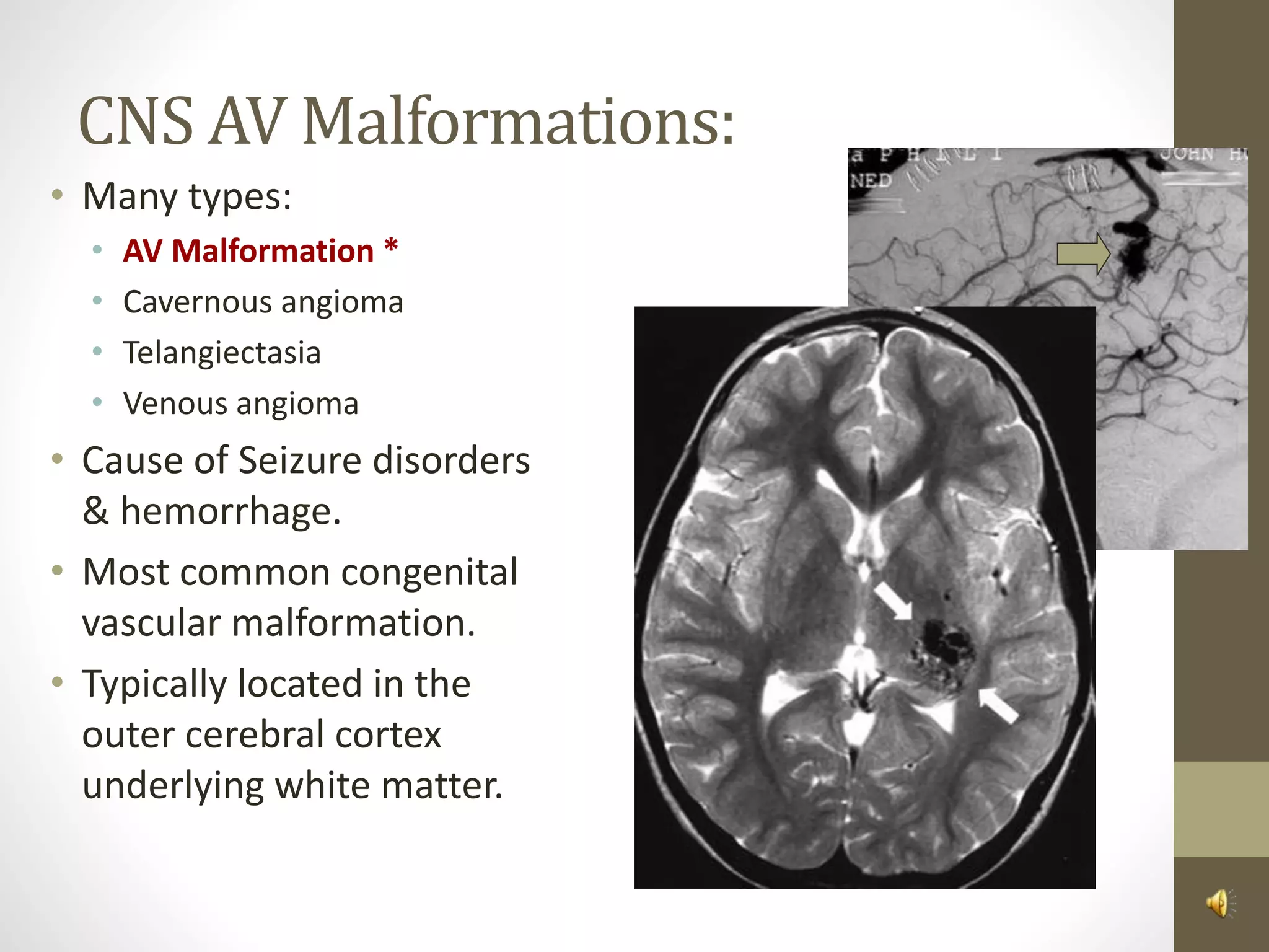 CNS AV Malformations:
• Many types:
• AV Malformation *
• Cavernous angioma
• Telangiectasia
• Venous angioma
• Cause of Seizure disorders
& hemorrhage.
• Most common congenital
vascular malformation.
• Typically located in the
outer cerebral cortex
underlying white matter.
 