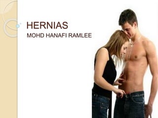 HERNIAS
MOHD HANAFI RAMLEE
 
