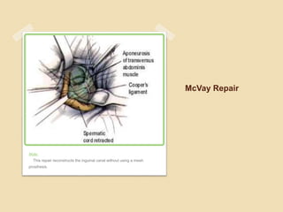 Mcvay Incision Hernias by MHR Corp | PPTX