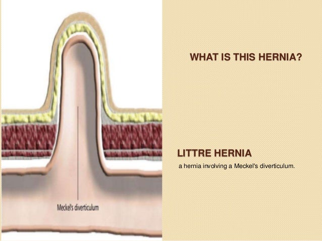 Hernias by MHR Corp