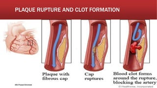 PLAQUE RUPTURE AND CLOT FORMATION
@Dr.Prasad Chinchole
 