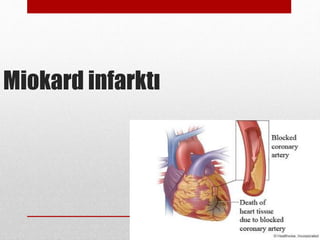 Miokard infarktı
 