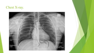 Chest X-ray.
 