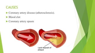 CAUSES
 Coronary artery disease (atherosclerosis).
 Blood clot
 Coronary artery spasm
 