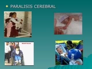 PARALISIS CEREBRAL 