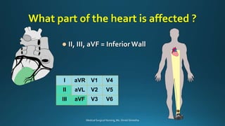 Acute Coronary Syndrome: MI | PPTX