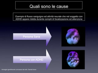 Quali sono le cause

                    Esempio di flusso sanguigno ed attività neurale che nel soggetto con
                    ADHD appare ridotta durante compiti di focalizzazione ed attenzione




                               Persona Sana




                          Persona con ADHD


immagini gentilmente concesse dal dott. Daniel Amen
 