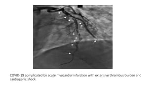 COVID‐19 complicated by acute myocardial infarction with extensive thrombus burden and
cardiogenic shock
 