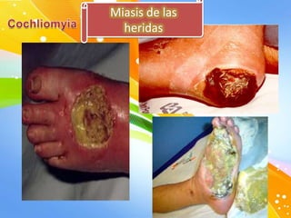 Miasis de las
heridas

 