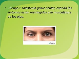- Grupo I:  Miastenia grave ocular, cuando los síntomas están restringidos a la  musculatura de los ojos. 