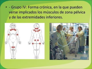 - Grupo IV: Forma crónica, en la que pueden verse implicados los músculos de zona pélvica y de las extremidades inferiores. 