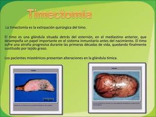 La timectomía es la extirpación quirúrgica del timo.  El timo es una glándula situada detrás del esternón, en el mediastino anterior, que desempeña un papel importante en el sistema inmunitario antes del nacimiento. El timo sufre una atrofia progresiva durante las primeras décadas de vida, quedando finalmente sustituido por tejido graso. Los pacientes miasténicos presentan alteraciones en la glándula tímica. 
