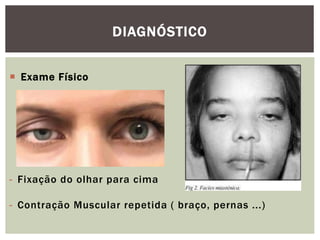 Exame Físico
- Fixação do olhar para cima
- Contração Muscular repetida ( braço, pernas ...)
DIAGNÓSTICO
 