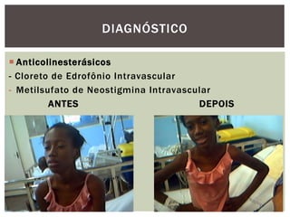 Anticolinesterásicos
- Cloreto de Edrofônio Intravascular
- Metilsufato de Neostigmina Intravascular
ANTES DEPOIS
DIAGNÓSTICO
 