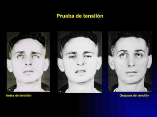 Despues de tensilón Prueba de tensilón Antes de tensilón 