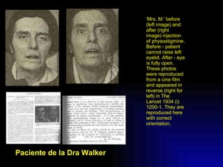Paciente de la Dra Walker 'Mrs. M.' before (left image) and after (right image) injection of physostigmine.  Before - patient cannot raise left eyelid. After - eye is fully open. These photos were reproduced from a cine film and appeared in reverse (right for left) in The Lancet 1934 (i) 1200-1. They are reproduced here with correct orientation.  