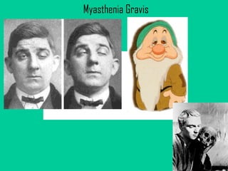 Myasthenia Gravis                                                 