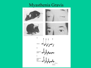 Myasthenia Gravis 