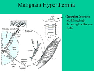 Malignant Hyperthermia  Dantrolene  (interferes with EC coupling by decreasing Ca exflux from the SR 