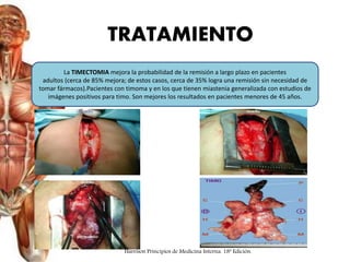 La TIMECTOMIA mejora la probabilidad de la remisión a largo plazo en pacientes
adultos (cerca de 85% mejora; de estos casos, cerca de 35% logra una remisión sin necesidad de
tomar fármacos).Pacientes con timoma y en los que tienen miastenia generalizada con estudios de
imágenes positivos para timo. Son mejores los resultados en pacientes menores de 45 años.
TRATAMIENTO
Harrison Principios de Medicina Interna. 18ª Edición.
 