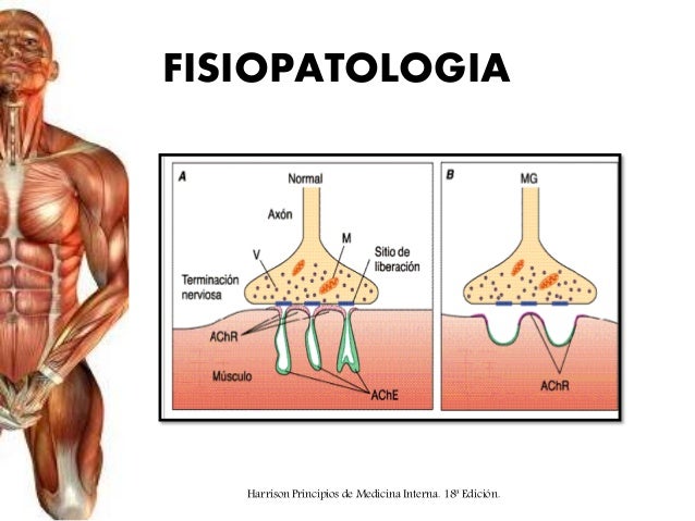 Resultado de imagen para miastenia grave