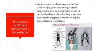 Timectomia Miastenia gravis | PPTX
