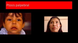 Ptosis palpebral