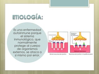Es una enfermedad 
autoinmune porque 
el sistema 
inmunológico, que 
normalmente 
protege al cuerpo 
de organismos 
externos, se ataca a 
sí mismo por error. 
 
