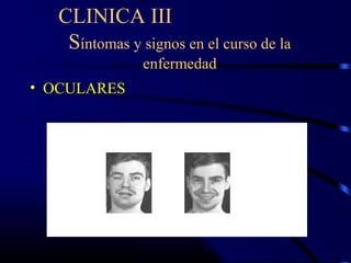 CLINICA III
Síntomas y signos en el curso de la
enfermedad
• OCULARES
 