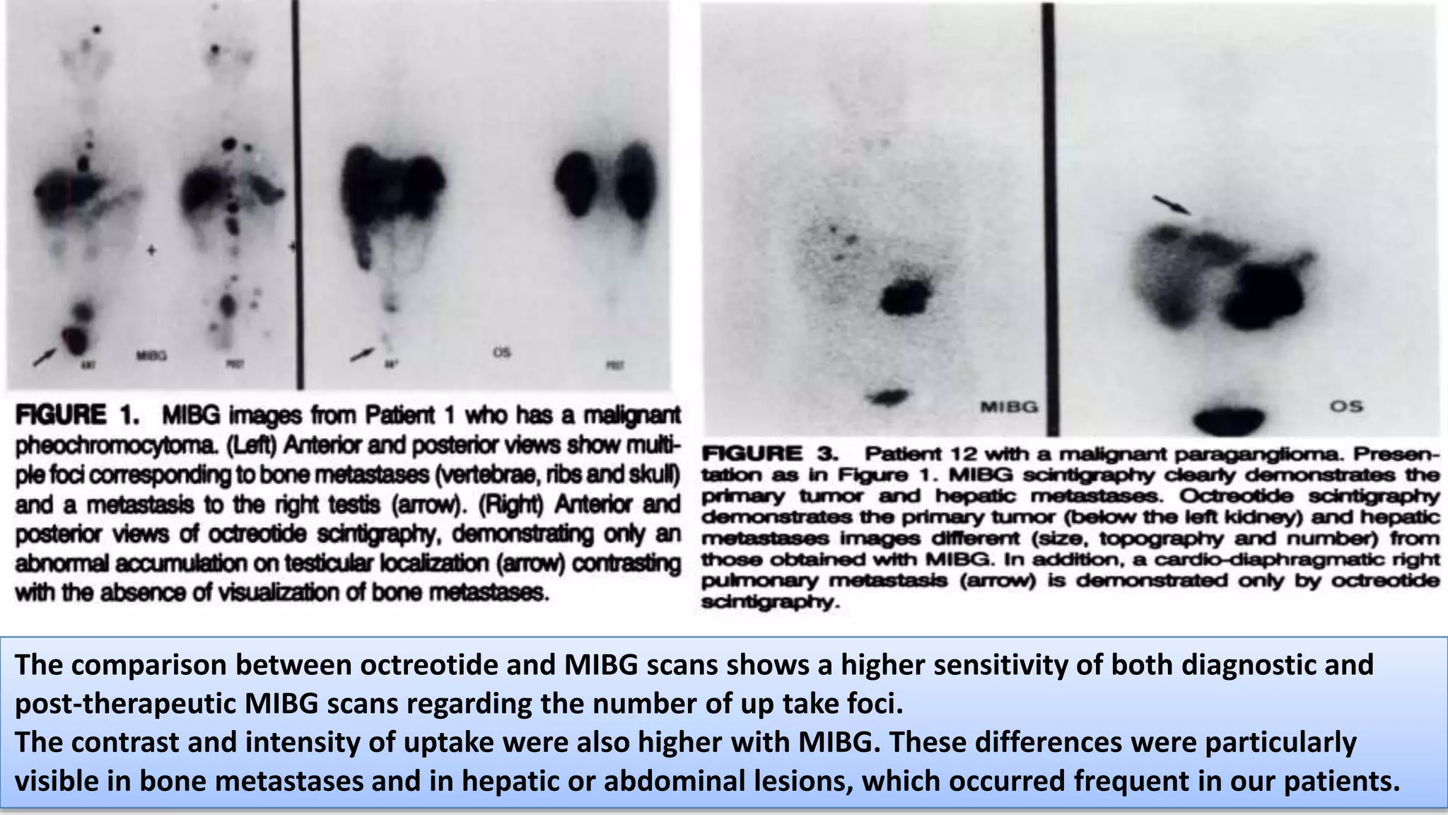 The comparison between octreotide and MIBG scans shows a higher sensitivity of both diagnostic and
post-therapeutic MIBG scans regarding the number of up take foci.
The contrast and intensity of uptake were also higher with MIBG. These differences were particularly
visible in bone metastases and in hepatic or abdominal lesions, which occurred frequent in our patients.
 