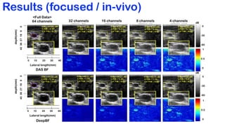 Deep Learning-Based Universal Beamformer for Ultrasound Imaging | PDF
