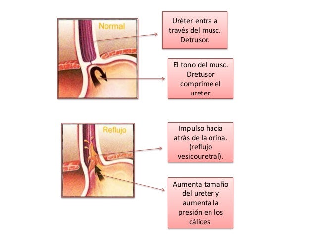 UrÃ©ter entra a travÃ©s del musc. Detrusor. El tono del musc. Dretusor comprime el ureter. Impulso hacia atrÃ¡s de la orina. ...