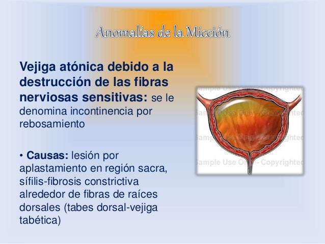 Resultado de imagen para La vejiga atónica y la incontinencia debidas a la destrucción de las fibras nerviosas sensitivas.