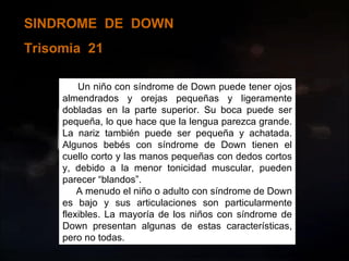 SINDROME  DE  DOWN Trisomia  21 Un niño con síndrome de Down puede tener ojos almendrados y orejas pequeñas y ligeramente dobladas en la parte superior. Su boca puede ser pequeña, lo que hace que la lengua parezca grande. La nariz también puede ser pequeña y achatada. Algunos bebés con síndrome de Down tienen el cuello corto y las manos pequeñas con dedos cortos y, debido a la menor tonicidad muscular, pueden parecer “blandos”. A menudo el niño o adulto con síndrome de Down es bajo y sus articulaciones son particularmente flexibles. La mayoría de los niños con síndrome de Down presentan algunas de estas características, pero no todas. 