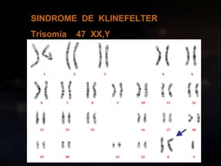SINDROME  DE  KLINEFELTER Trisomia  47  XX,Y 