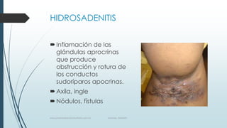HIDROSADENITIS
Inflamación de las
glándulas aprocrinas
que produce
obstrucción y rotura de
los conductos
sudoríparos apocrinas.
Axila, ingle
Nódulos, fístulas
www.pharmedsolutionsinstitute.com.mx Informes. 36246001
 
