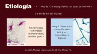 • Más de 70 microorganismos son causa de micetoma
Se divide en dos clases:
ACTINOMICETOMA EUMICETOMA
Actinomicetos
filamentosos
(microsifonados)
aerobios gram +
Hongos filamentosos
(macrosifonados)
tabicados,
pigmentados o
blancos
Bonifaz A. Micología médica básica. 4th Ed. 2012. McGraw Hill.
 