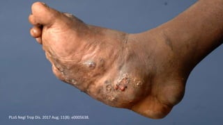 PLoS Negl Trop Dis. 2017 Aug; 11(8): e0005638.
 