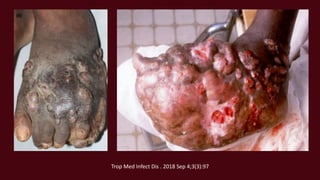 Trop Med Infect Dis . 2018 Sep 4;3(3):97
 